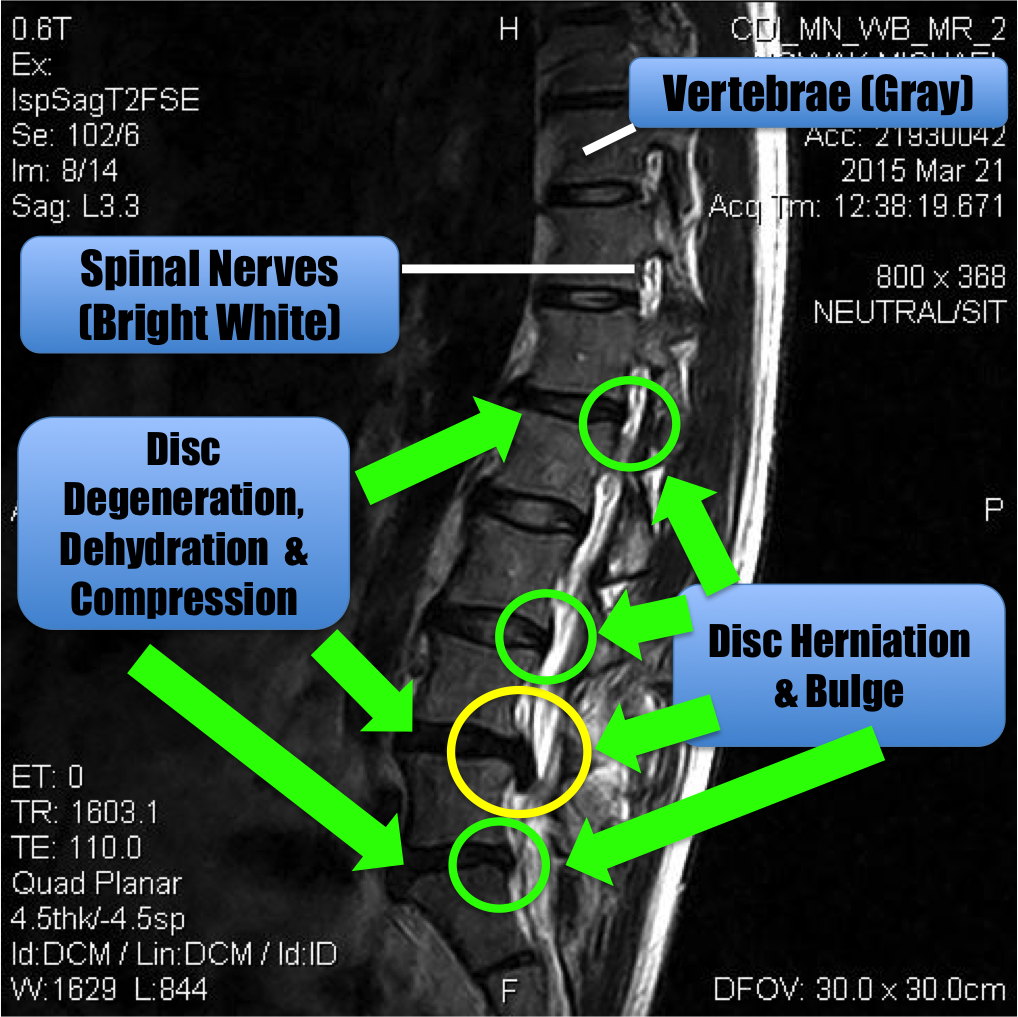 lower disc injury mri spine update howdoigetripped lumbar pain imaging anatomy brain prognosis radiology report especially pronounce upper