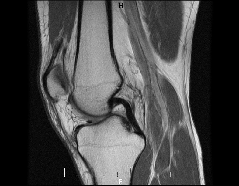 Mike Right Knee MRI